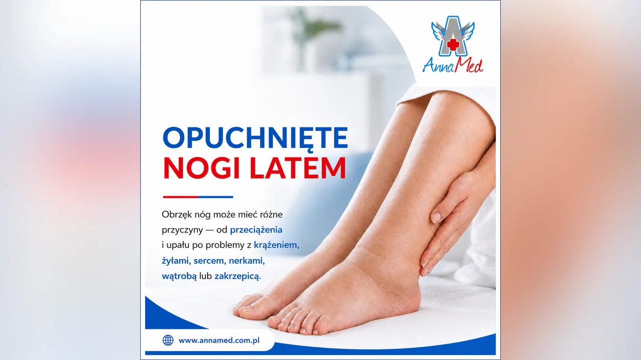 Grafika AnnaMed: Opuchnięte nogi latem – co może być przyczyną?