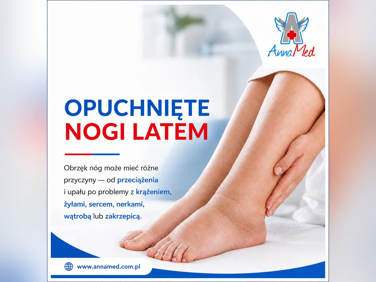 Grafika AnnaMed: Opuchnięte nogi latem – co może być przyczyną?